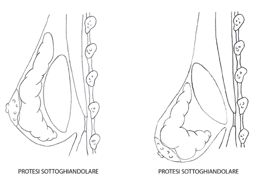 protesi sottoghiandolare