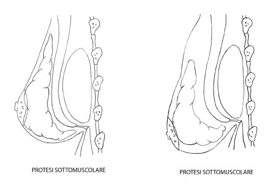 protesi sottomuscolare